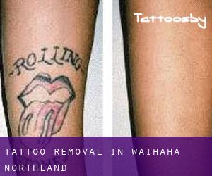 Tattoo Removal in Waihaha (Northland)