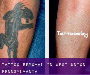 Tattoo Removal in West Union (Pennsylvania)