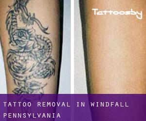 Tattoo Removal in Windfall (Pennsylvania)