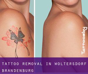 Tattoo Removal in Woltersdorf (Brandenburg)