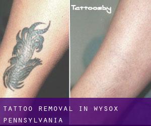 Tattoo Removal in Wysox (Pennsylvania)