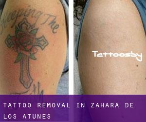 Tattoo Removal in Zahara de los Atunes