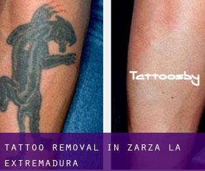 Tattoo Removal in Zarza (La) (Extremadura)